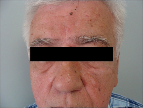 Skin cancers of the face and pigmented keratoses - after a year